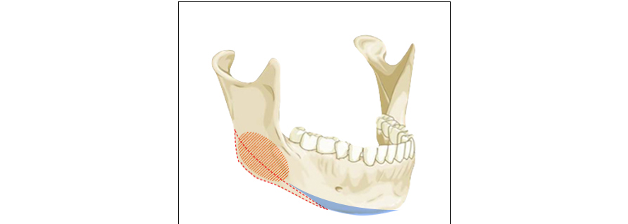 피질골 두께까지 축소하는 절골 범위 도해
