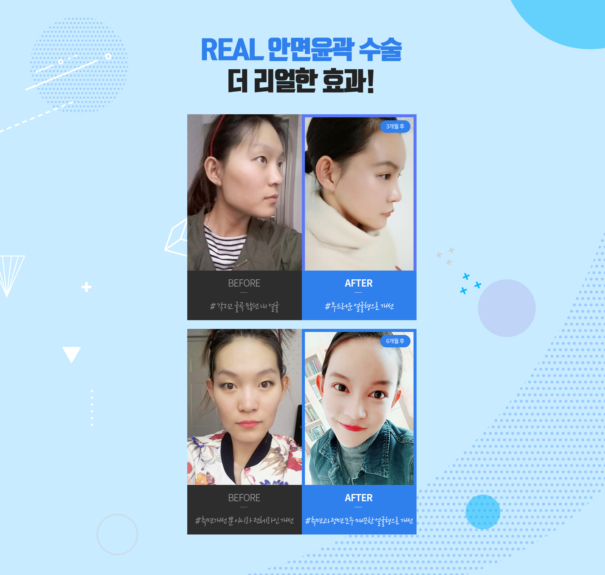 REAL 안면윤곽 수술 더 리얼한 효과! — 현대미학 사각턱축소술 REAL 전후사진