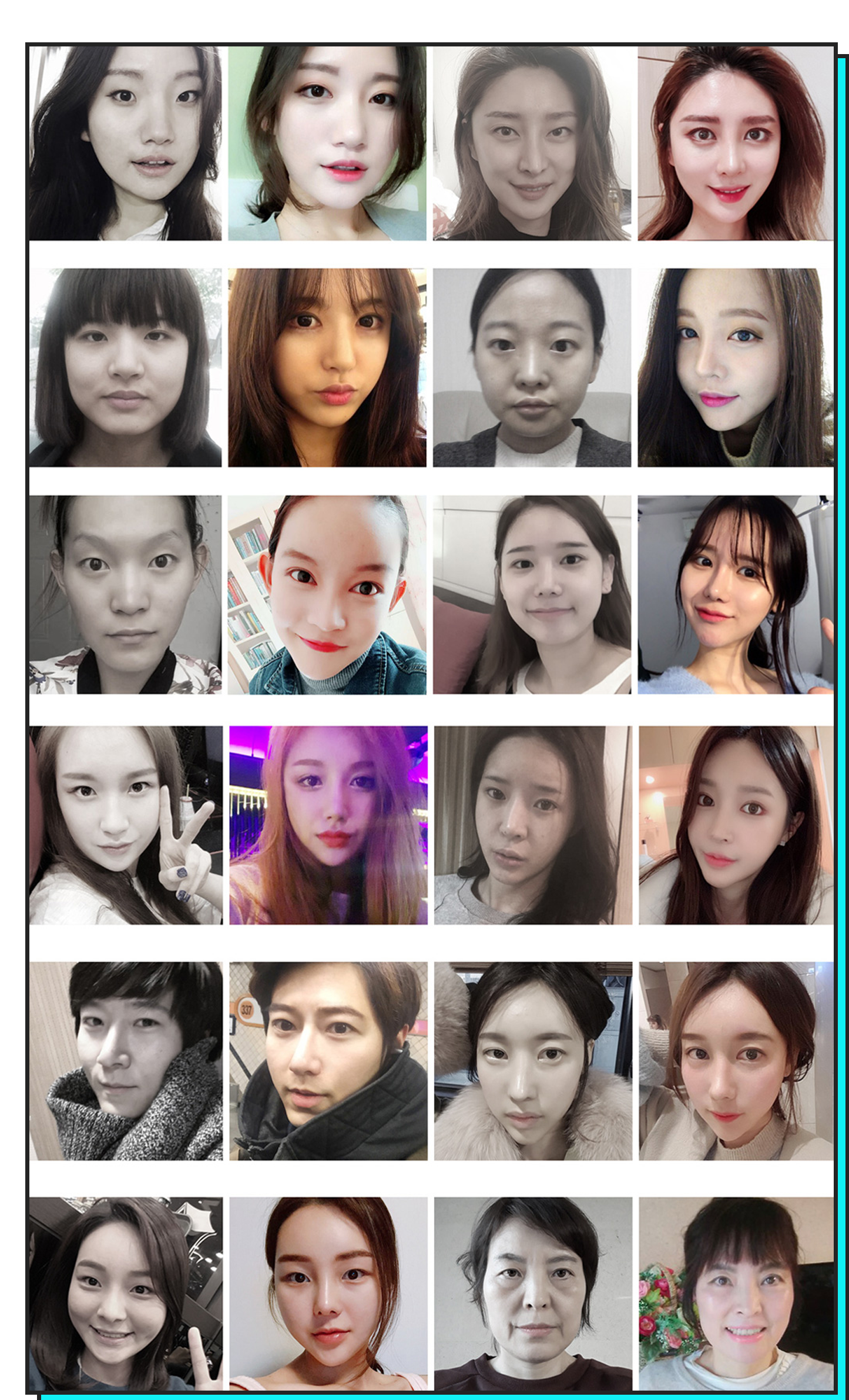 현대미학 트임재수술 BEFORE & AFTER 사례