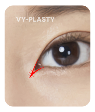 V-Y피판술 일러스트