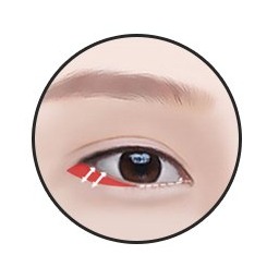 밑트임 2단계 — 결막 절개 후 골막 고정