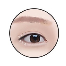 밑트임 3단계 — 흉터 없는 봉합