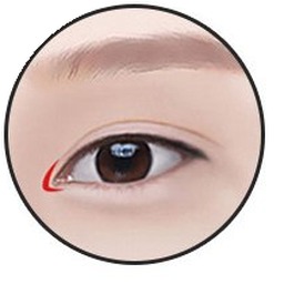 앞트임 2단계 — 몽고주름 절개