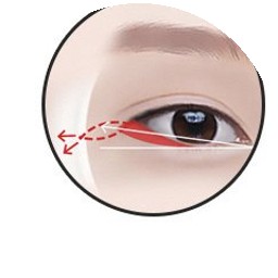 뒤트임 3단계 — 외안각 골막 고정
