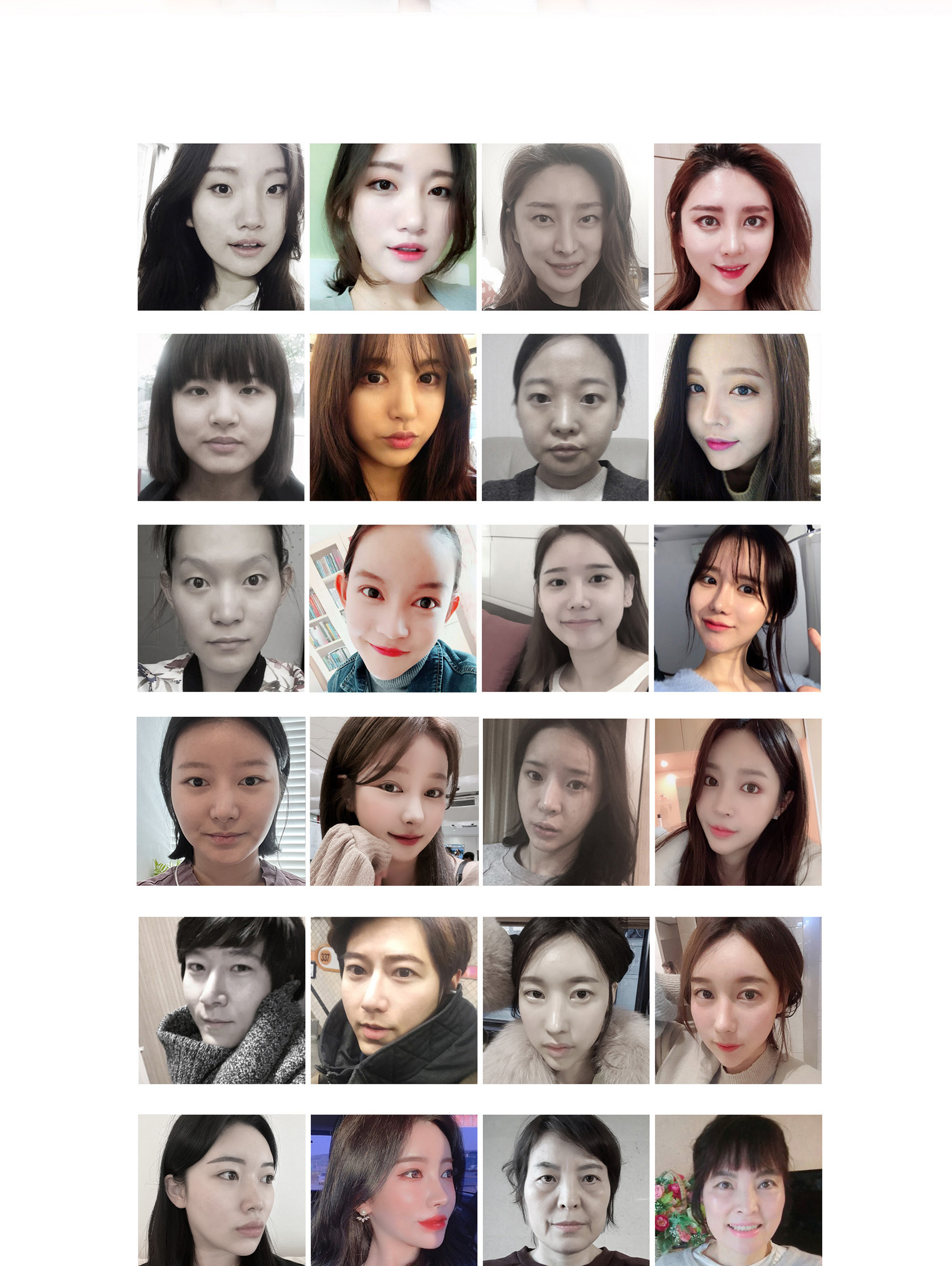 입술 비대칭 교정술 Before & After 사례