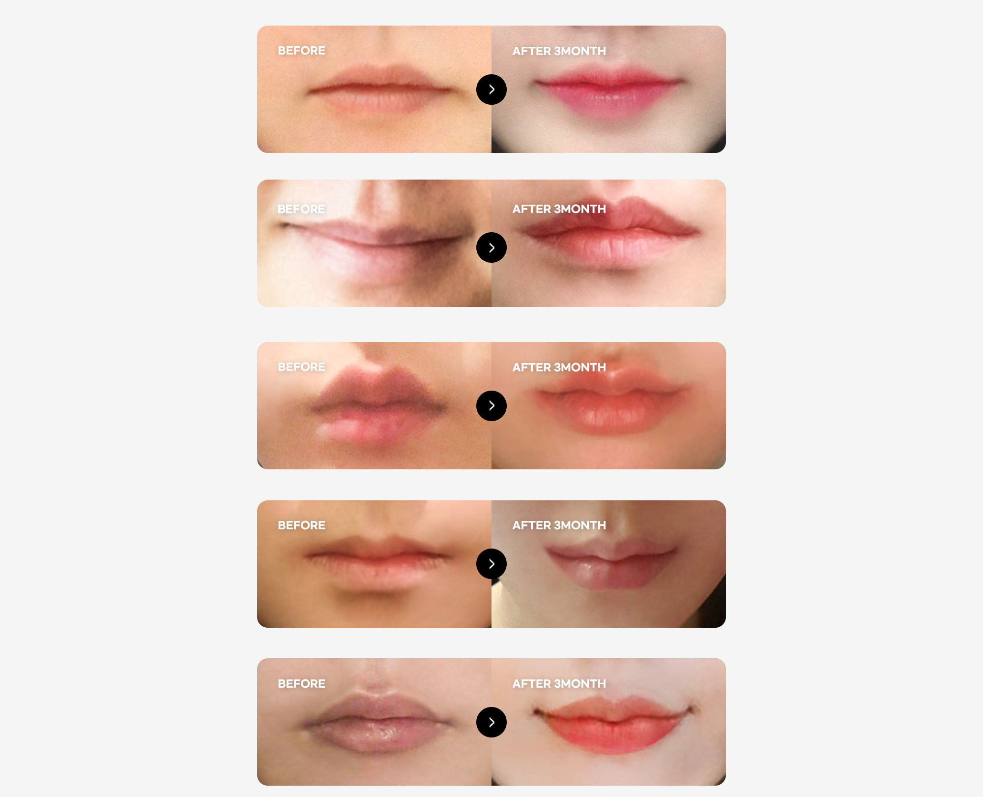 큐피트 입술성형 BEFORE & AFTER 사례