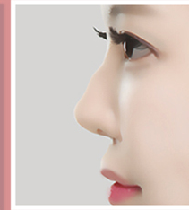 매부리코 측면 사례 2