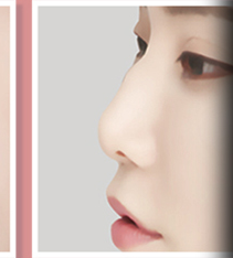 매부리코 측면 사례 3