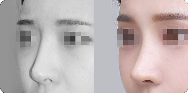 무보형물 코성형 전후 측면 비교 2 (BEFORE / AFTER 3MONTH)