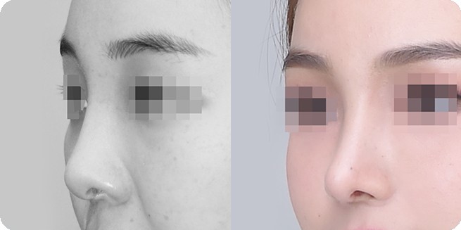 무보형물 코성형 전후 측면 비교 3 (BEFORE / AFTER 3MONTH)