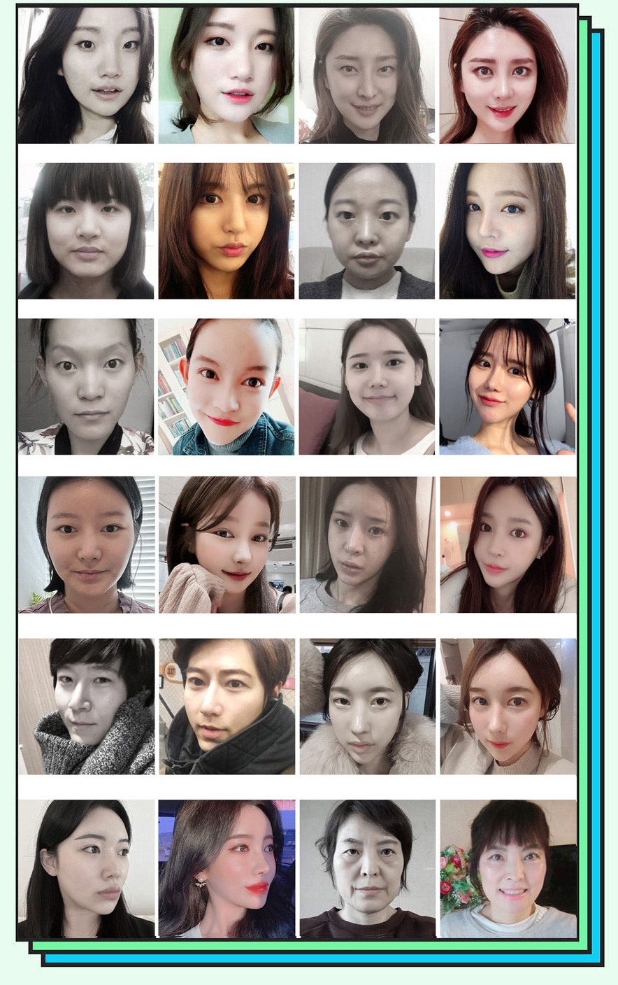 현대미학 휘어진코 성형 전후 비교 사진