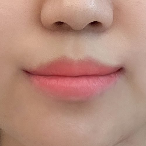 입술 성형 가지고 왔어요!