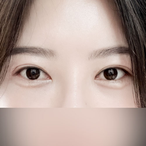 눈재수술 해봤어요