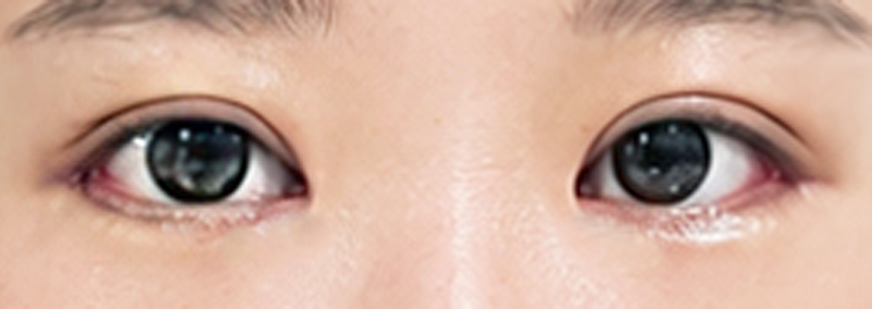 딸 성형시켜줬어요~