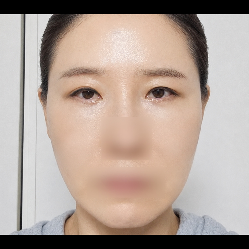 눈매교정+뒤트임 후기