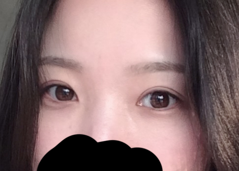 눈재수술 다신 안할꺼예요