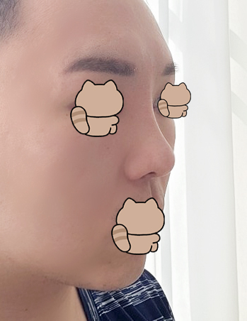 코 성형 마음에 들어